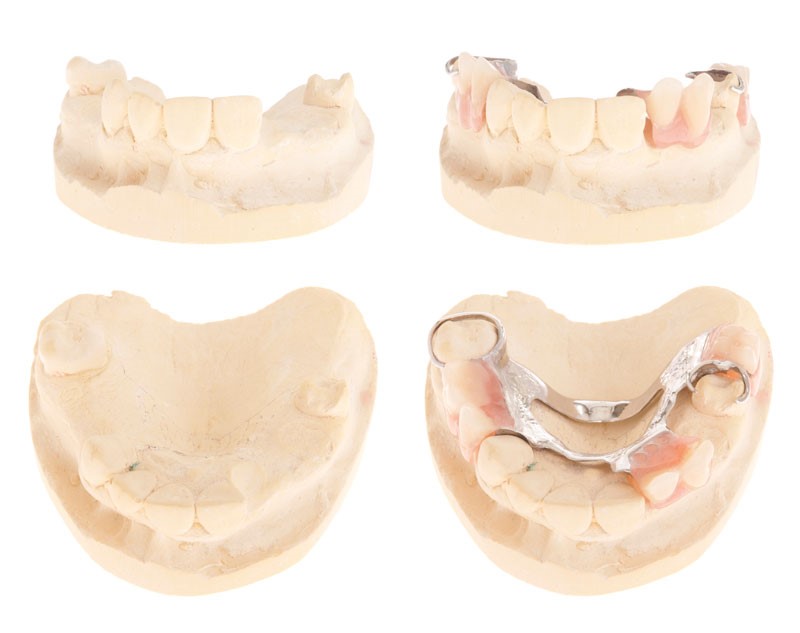 Permanent Dentures Procedure Meridian MS 39307